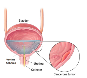 افزیاش سرطان مثانه
